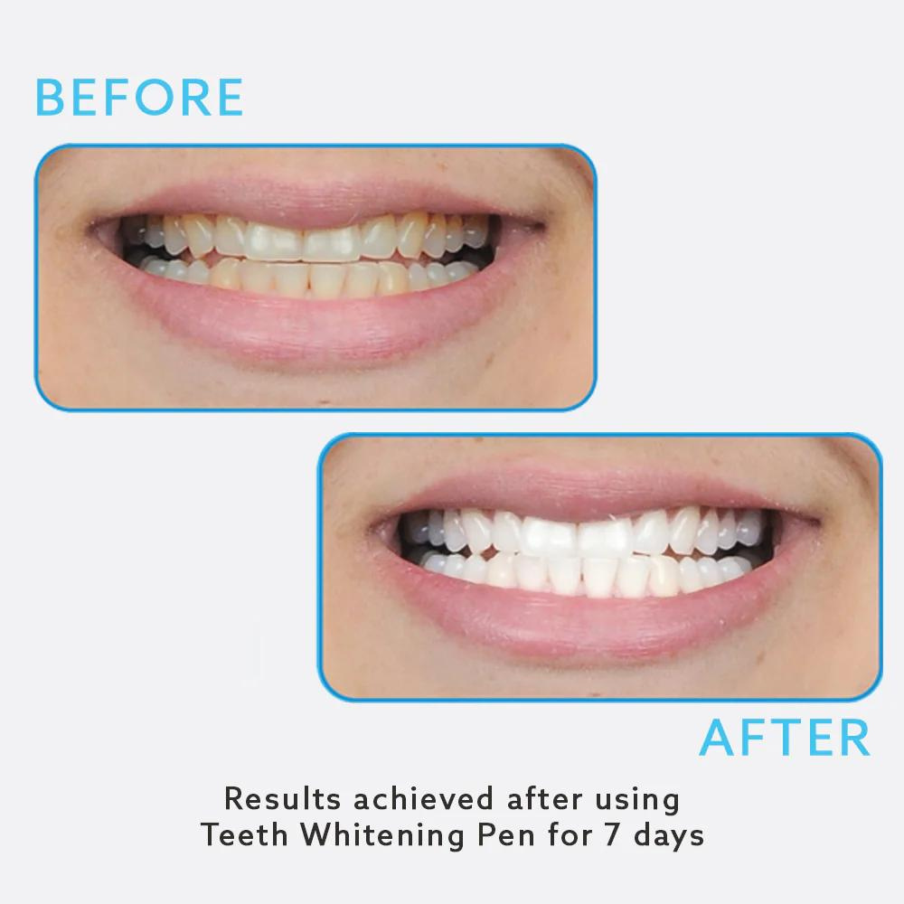 On The Go Teeth Whitening Pen 3-Pack