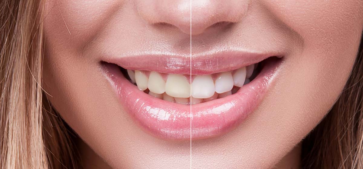 smile before and after whitening treatment
