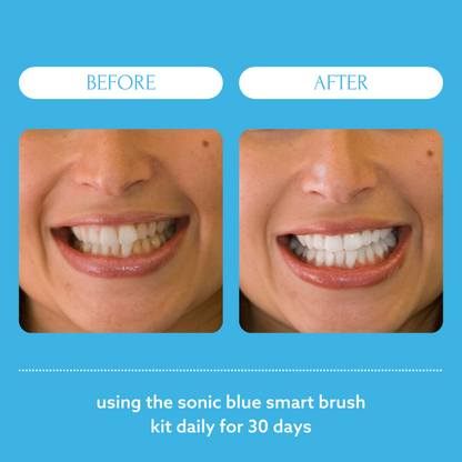 Teeth Whitening Essentials Kit