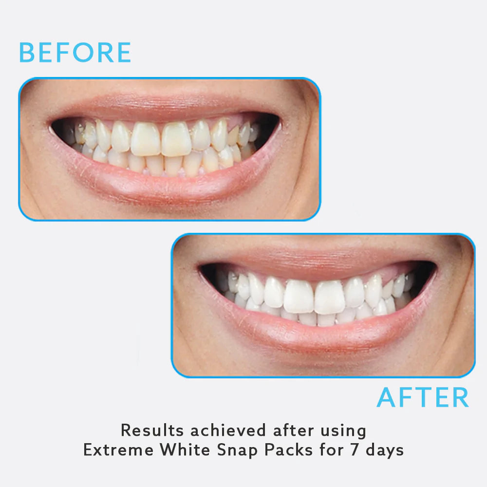 Boost &amp; Maintain Teeth Whitening Kit